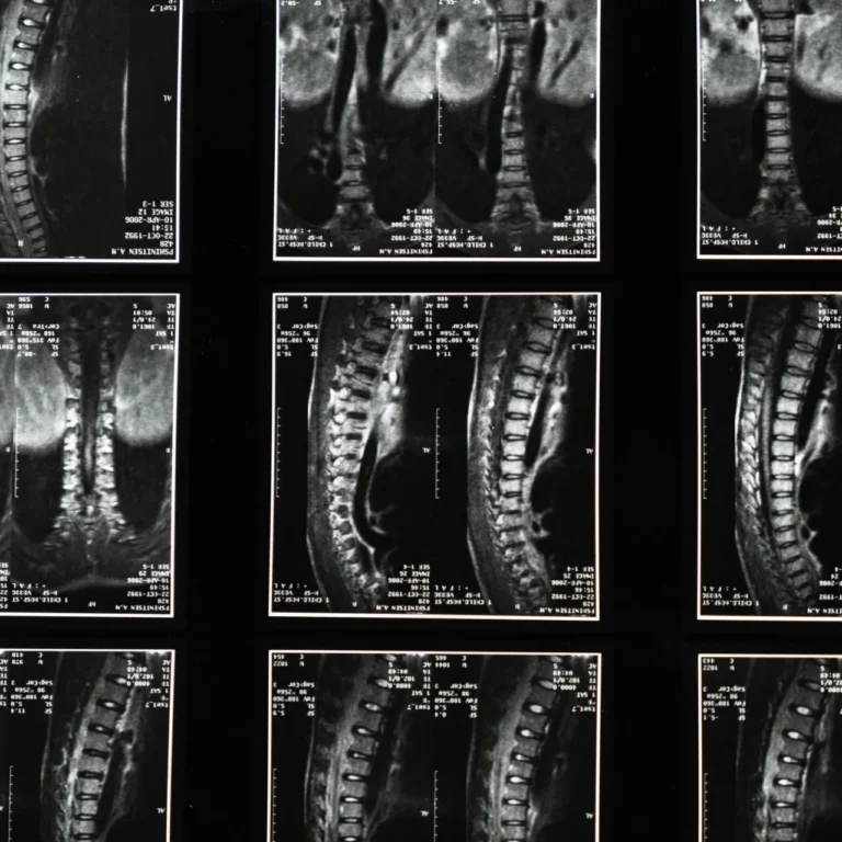 New Orleans Spinal Injuries Lawyer