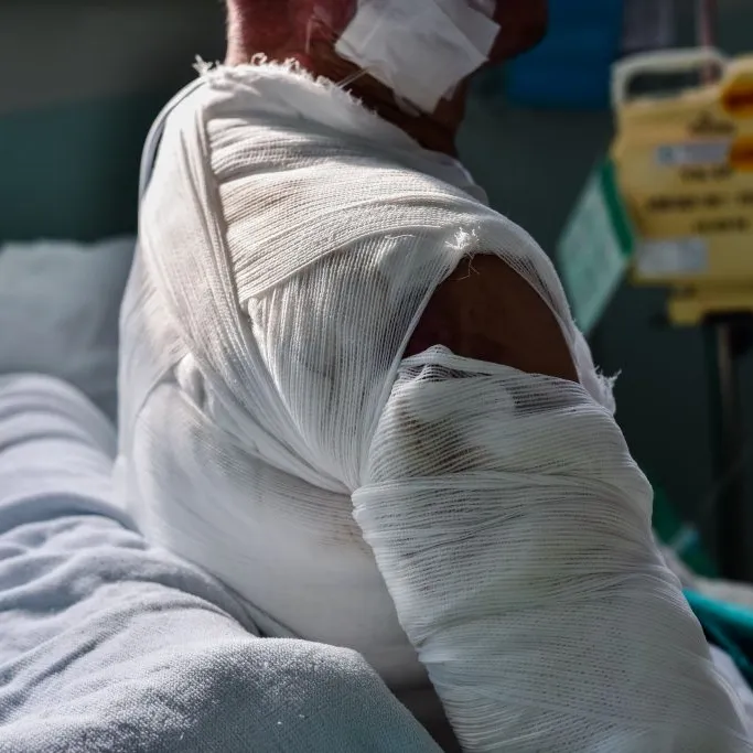 New Orleans Burn Injury Attorney