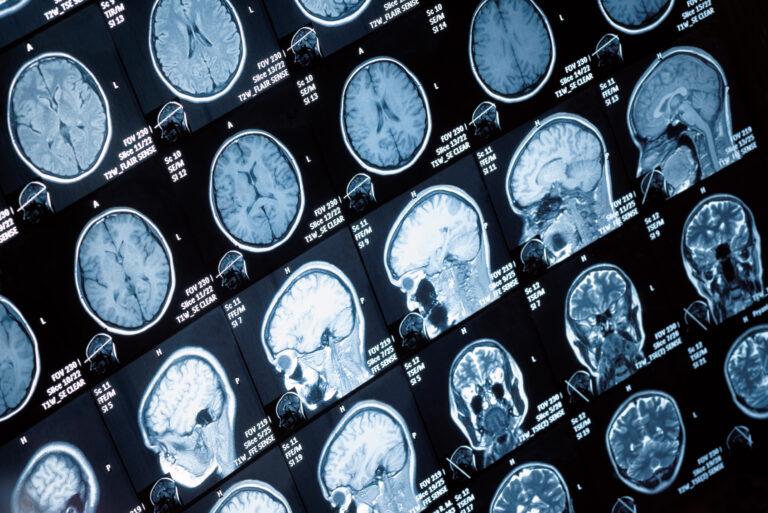 Franklinton Traumatic Brain Injury Lawyer