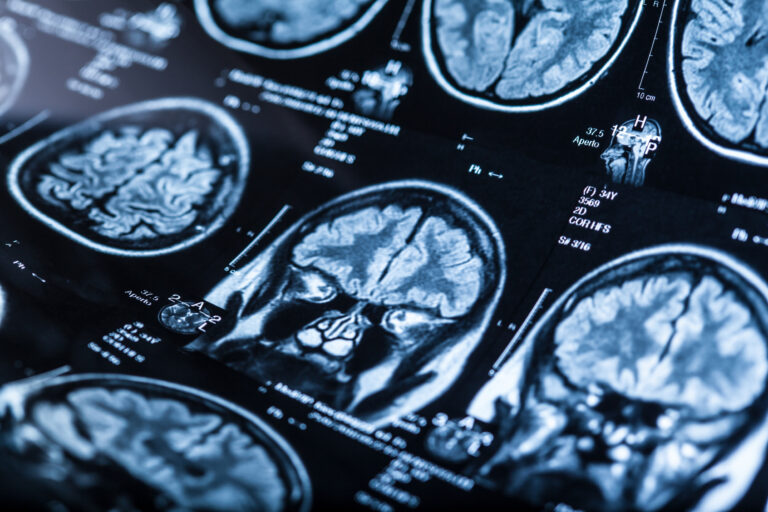 Metairie Traumatic Brain Injury Lawyer